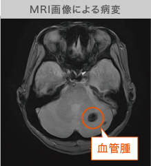 MRI画像による病変
